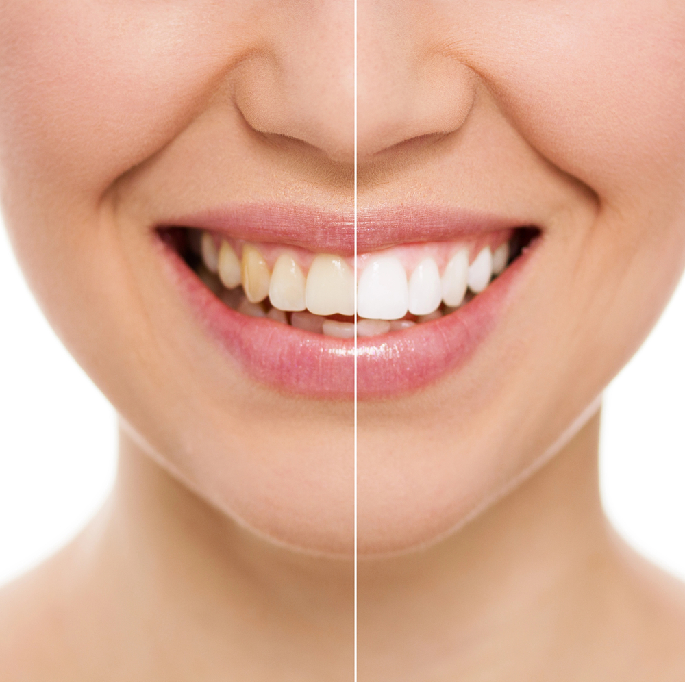 teeth whitening in oakville