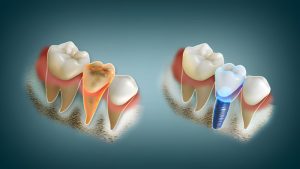 Dental Crowns