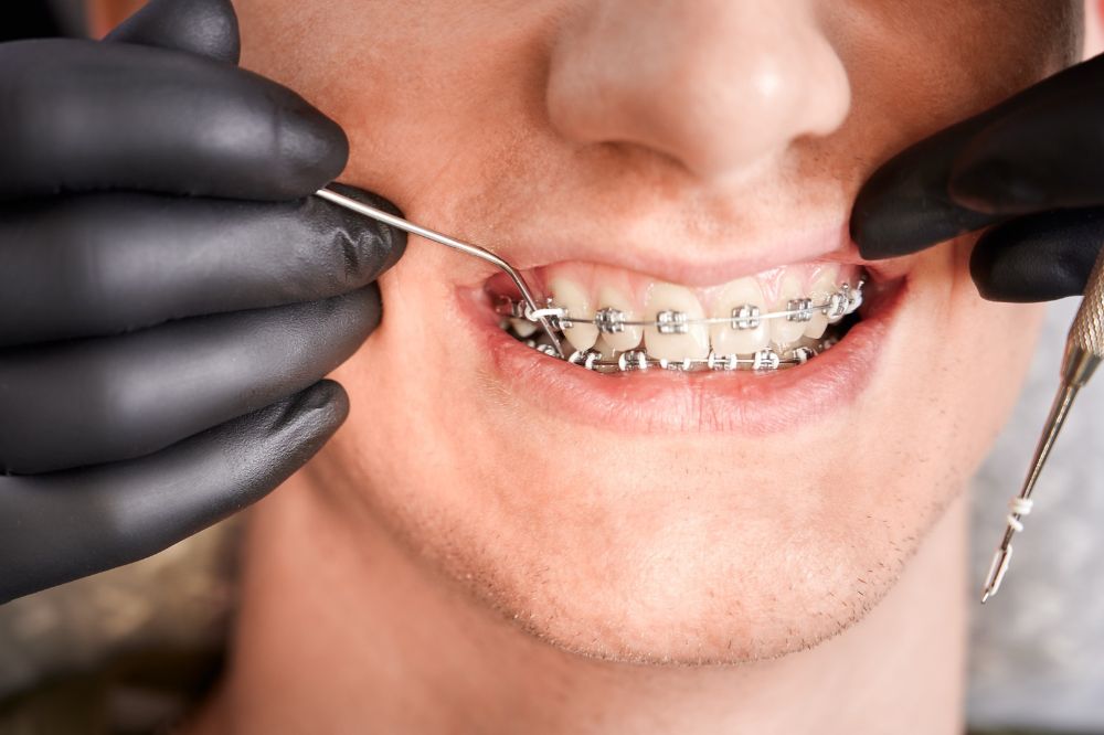 braces treatment